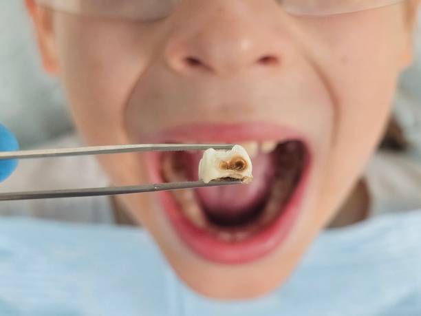 Best Emergency Treatment for Oral Infections in Milton, WA